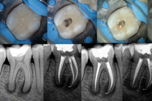 Endodoncia