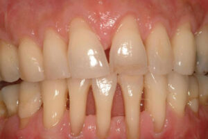 periodontitis